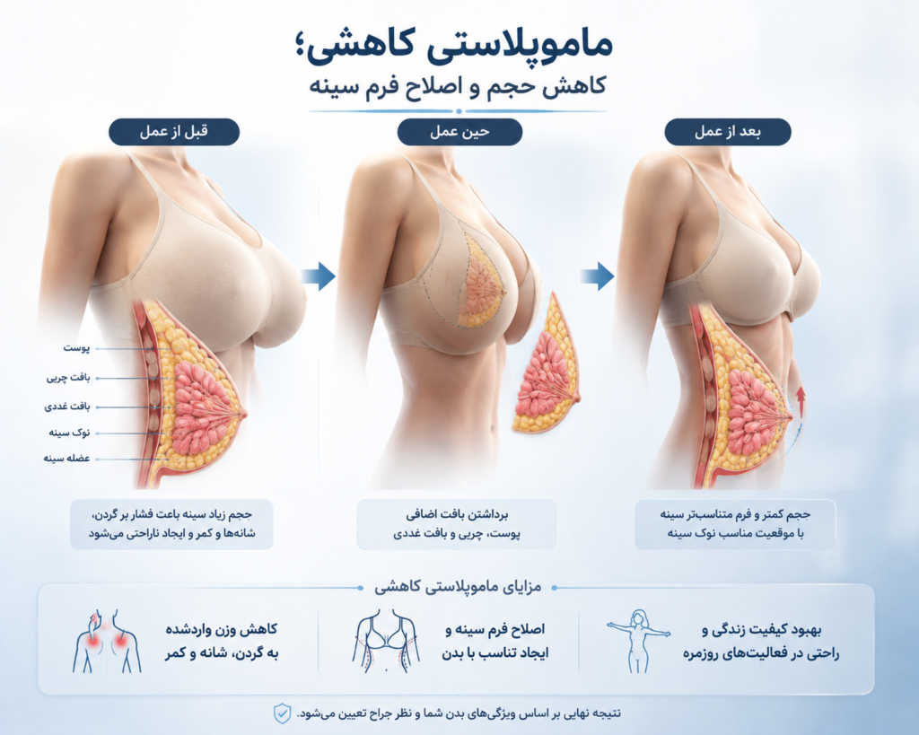 درمان ماکروماستی